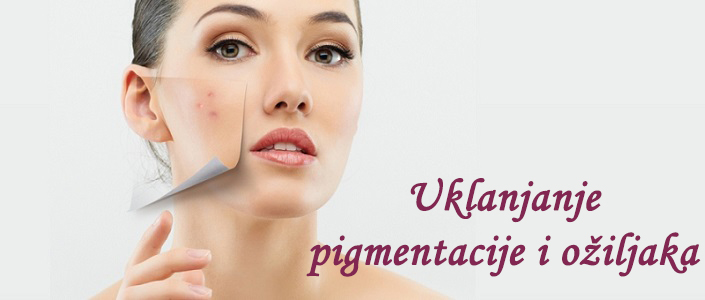 Uklanjanje pigmentacija, ožiljaka1